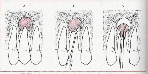 Apical cystectomy performed at time of tooth removal. A to C, Removal with curette via tooth socket is visualized, A apical cystectomy must be performed with care because of proximity of apices of teeth to other structures, such as maxillary sinus and inferior alveolar canal