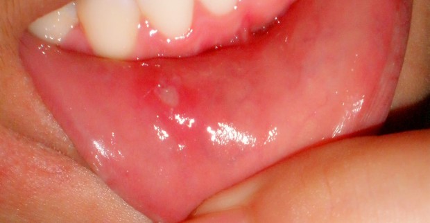 Aphthous Ulcer - Most Common Recurrent Oral Ulcer
