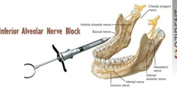 Video: Mandibular Anesthesia – Inferior Alveolar Nerve Block inf