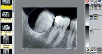 Recent Advances: Computerized Radiography "Digital X-ray"