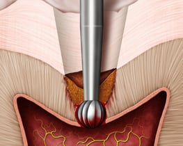 Conventional Burs 