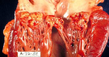 Infective Endocarditis