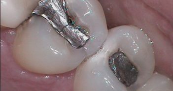 Failure of Amalgam Restoration: Isthmus Fracture