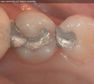 Failure of Dental Restorations