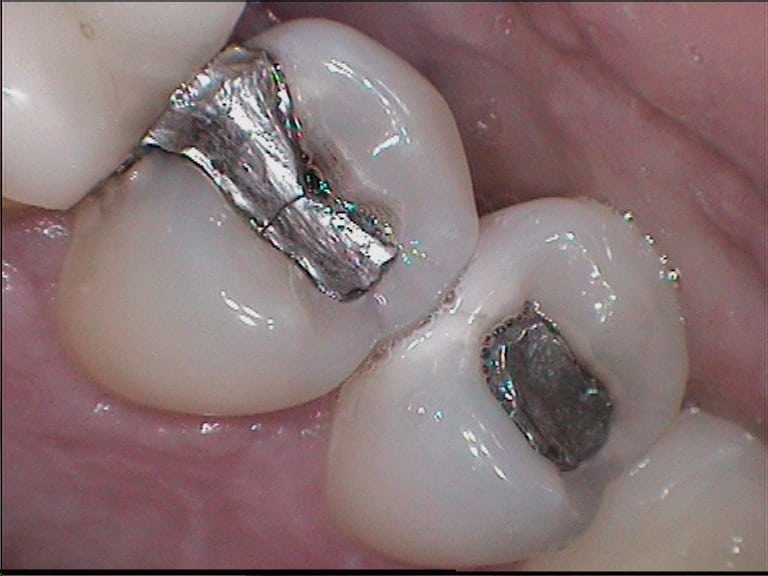 Amalgam restoration with a dental Failure what is it? OziDent