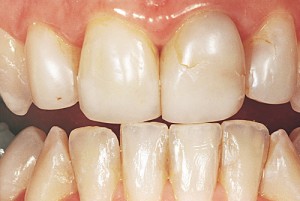 Failure of Dental Restorations