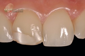 Failure of Dental Restorations