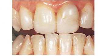Failure of Dental Restorations