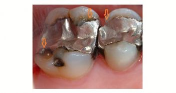 Failure of Amalgam Restoration: Marginal Degradation