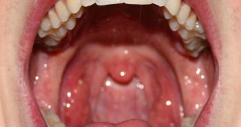 Intraoral Examination