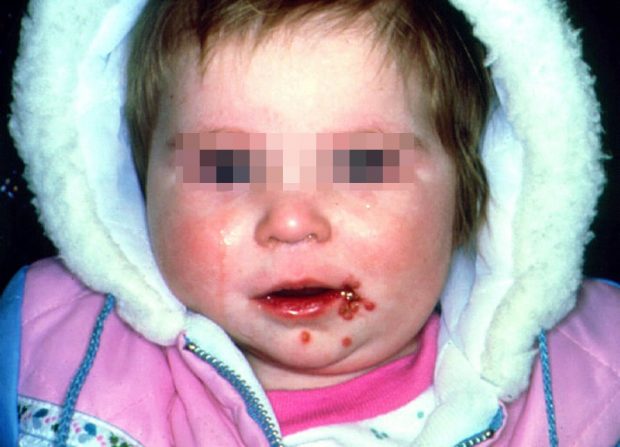 Primary Herpes In a Child