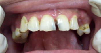 Case: DT04 – Rootless Tooth!