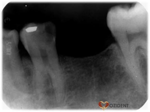 Preoperative radiograph