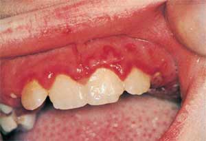 Acute Marginal Gingivitis