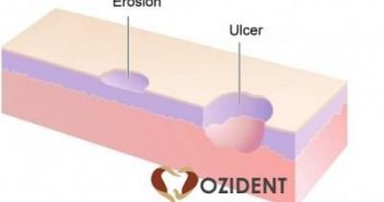 Oral Ulcers – General Classification