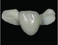 Adhesive Bridges – Clinical Studies