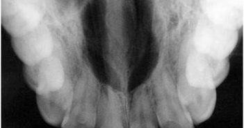 Periapical radiolucent lesions: Non-Pulpal Orginis.
