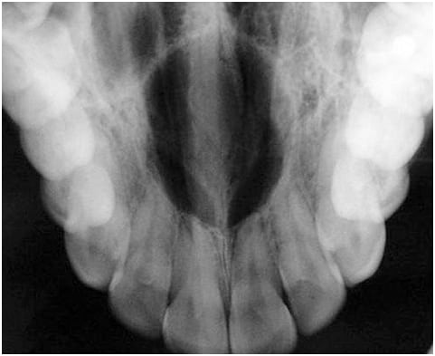 Nasopalatine Duct cyst