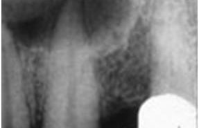 Periapical radiolucent lesions: Pulpal Orginis.