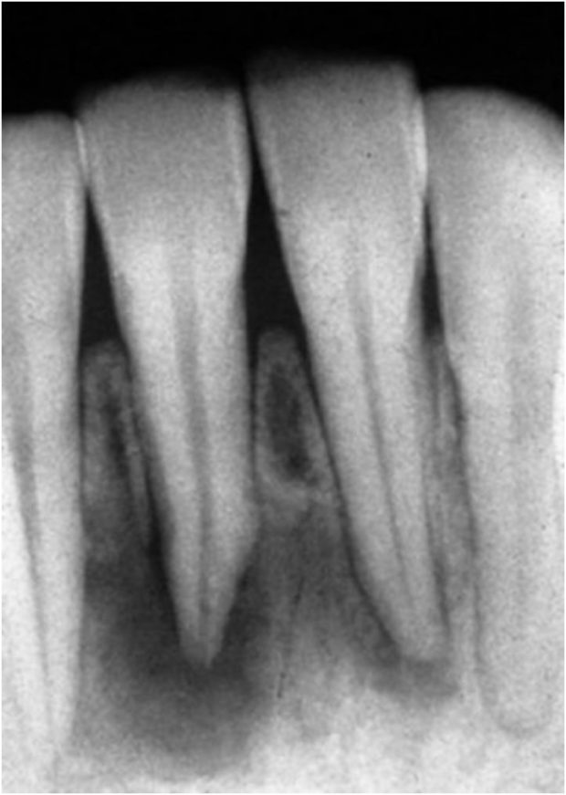 Cementoma 1st Stage