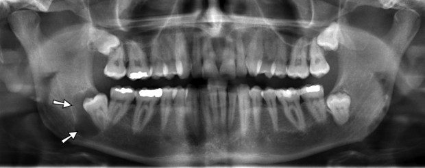 Cysts of the Jaw