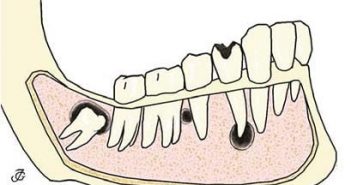 Cysts of the Jaw – Classifications Cysts of the Jaw