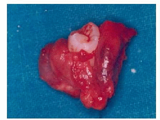  The enucleated cyst was sent for histopathological examination