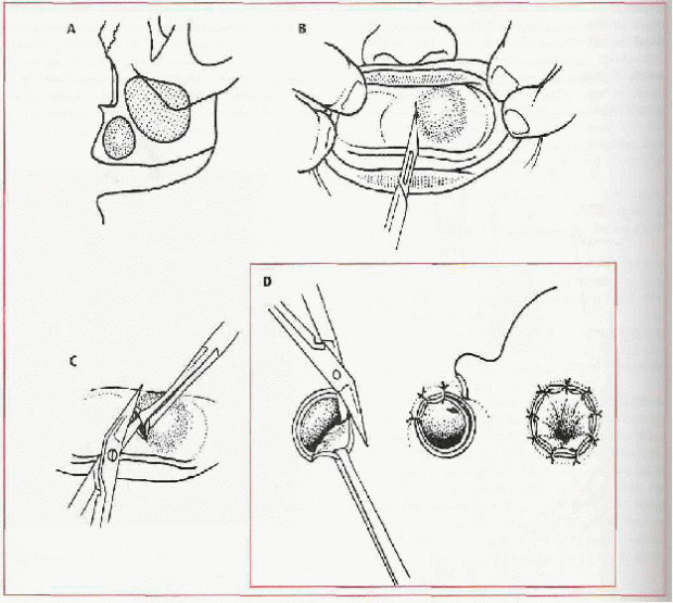 marsupialization technique