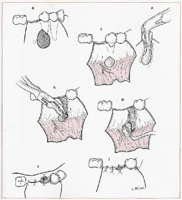 Removal of apical cyst by flap reflection and creation of osseous window is demonstrated at the time of tooth removal.