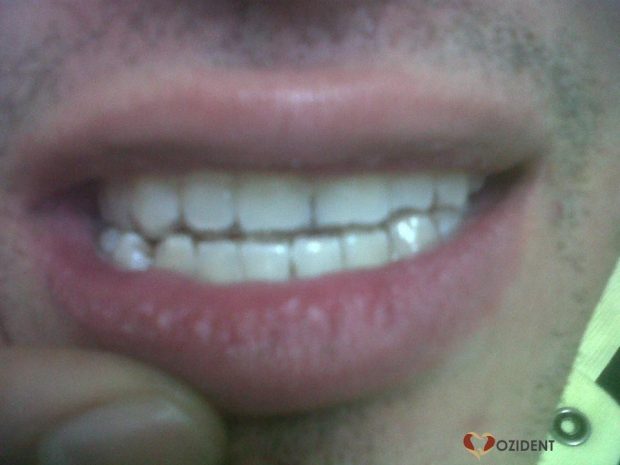 White Teeth !