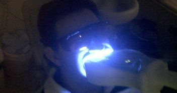 Case: DT05 – Yellowish Teeth!
