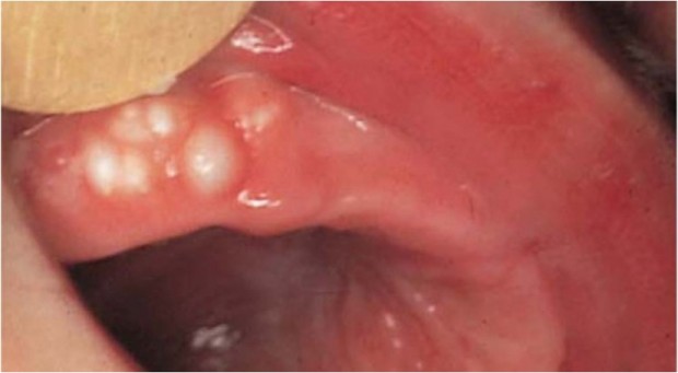 Bohn's nodules are mucous gland cysts, often found on the buccal or lingual aspects of the alveolar ridges and occasionally on the palate. They are multiple, firm, and grayish white in appearance. Histologically they show mucous glands and ducts