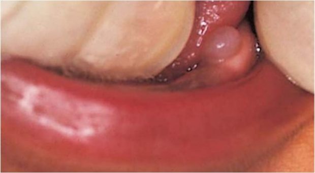 Dental lamina cysts are found only on the crest of the alveolar mucosa. Histologically, these lesions are different because they are formed by remnants of dental lamina epithelium. They may be larger, more lucent, and fluctuant than Epstein pearls or Bohn nodules and are more likely to occur singly.