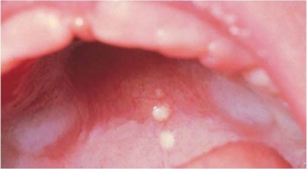 Epstein's pearls are keratin-filled cystic lesions lined with stratified squamous epithelium. They appear as small, whitish lesions along the midpalatine raphe and contain no mucous glands