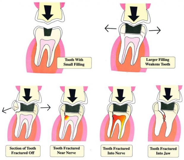 Consequence of Large filling 