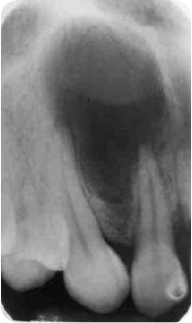 Globulomaxillary cyst showing the characteristic inverted pear-shaped appearance between the maxillary canine and lateral incisor.