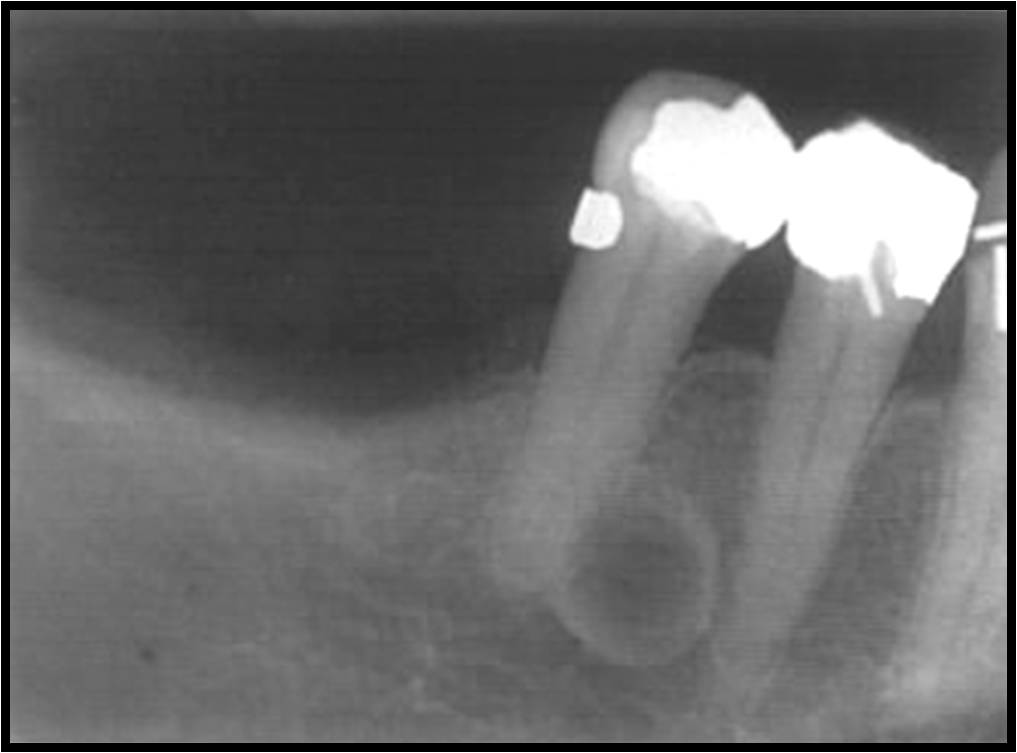 Radicular Cyst Radiology