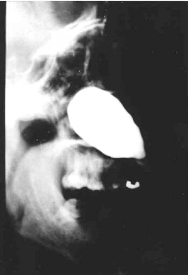 Nasolabial cyst is a soft tissue cyst which is made visible on the radiograph by injecting it with a radiopaque dye.