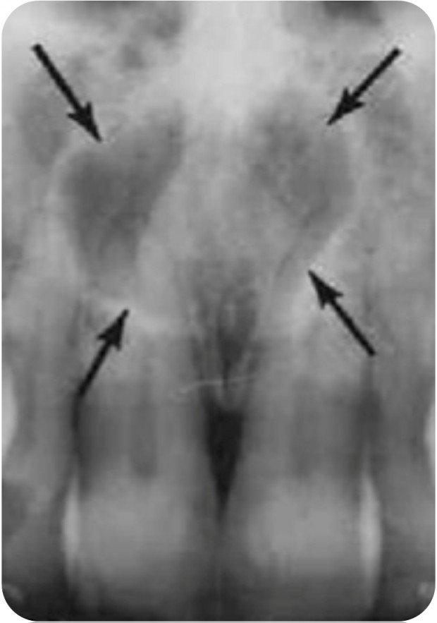 Circular-shaped nasopalatine duct cyst (incisive canal cyst) located in the region of the maxillary central incisors. The central incisors are vital and have intact periodontal ligament space and lamina dura.