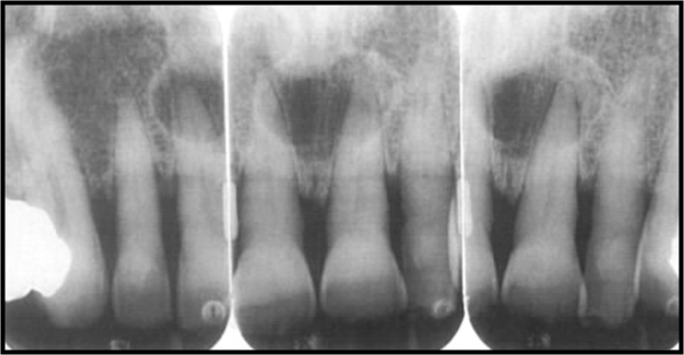 Nasopalatine cyst