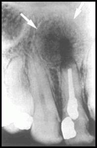 Radicular Cyst Healing After Endodontic Treatment, New Bone Is Growing Towards The Center From Periphery