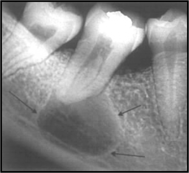 Well Defined Cortical Boundary Of Radicular Cyst