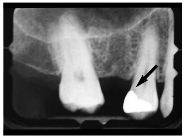 Radiography showing reccurent caries under amalgam restoration
