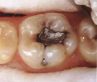 Recurrent caries around amalgam restoration as a dark area