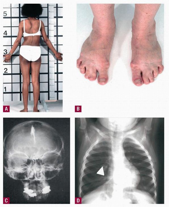 Gorlin syndrome Manifestations 