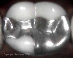 Freash and Shiny amalgam Filling