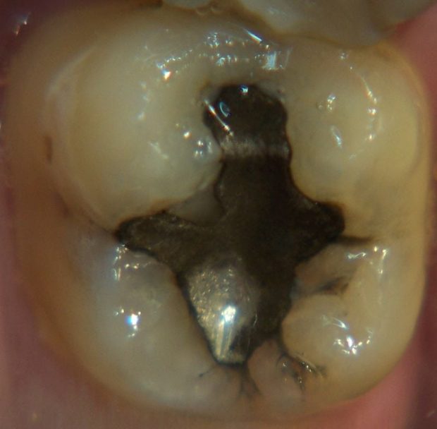 Tarnish : Loss of Amalgam Lister