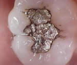 Corrosion leading to Amalgam Surface Pitting