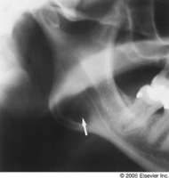 Static bone cyst