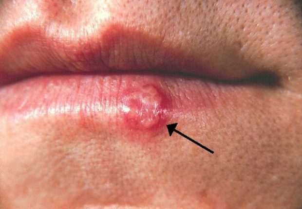 Recurrent Herpes Labialis